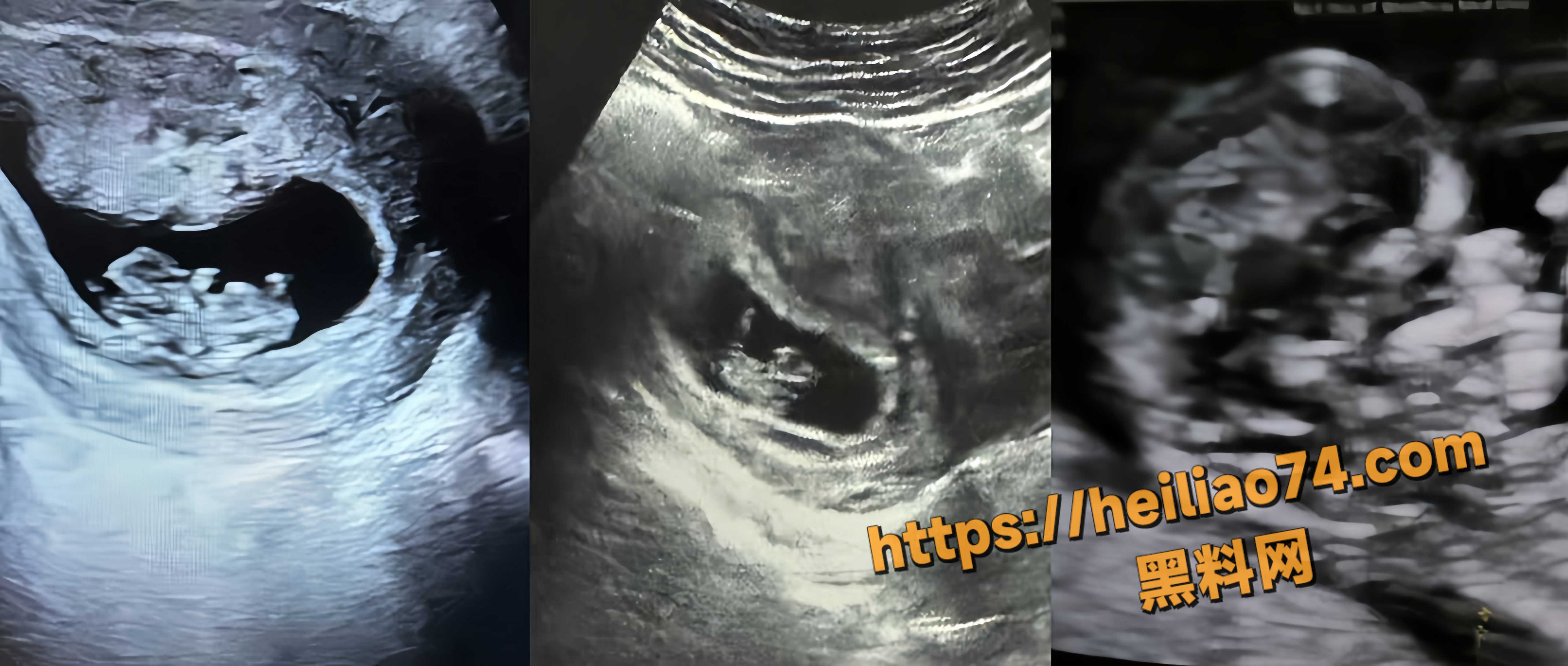 王玉米逼女友打胎 8
